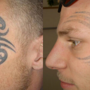 tatueringsborttagning-ansikte.jpg