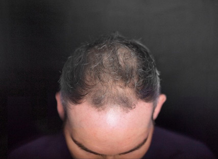 Före-bild PRP behandling mot tunt hår